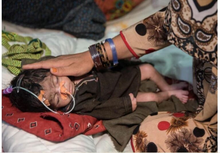 Child Malnutrition in Afghanistan Has Reached Its Worst Level, The United Nations Has Issued a Warning